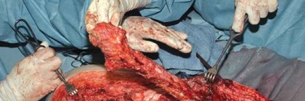 Illustration 73 for Optimizing Infected THA: The One Staged Approach Explained