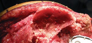 Illustration 4 for Understand Augments: The Role of Metal Augments in Arthroplasty