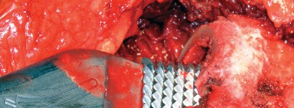 Illustration 26 for Cementless Femoral Stems: Master Indications & Avoid Pitfalls