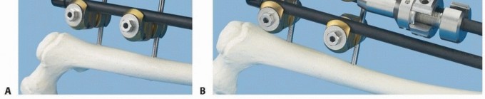 Mastering Femoral Shaft Fixation: How a Screw Is Inserted