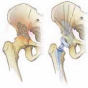 Illustration 8 for Advanced Arthroplasty for Malignant Lesions: Reclaim Your Mobility
