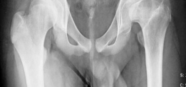 Illustration 2 for Conservative Head Reduction Osteotomy: Restoring Young Hip Function