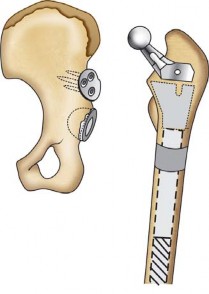 Illustration 132 for Successful Total Hip Replacement in Developmental Dysplasia