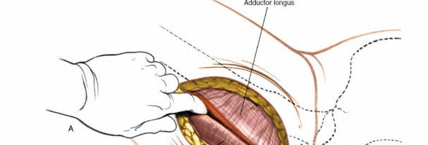 Illustration 216 for Unlocking Every Aspect of the Hip's Surgical Approaches