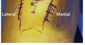 Illustration 22 for Advanced Nailing of the Mature Tibia: Overcoming Complexities