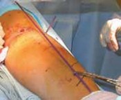 Illustration 19 for Pediatric Tibial Fractures: Avoid Mistakes, Ensure Optimal Healing