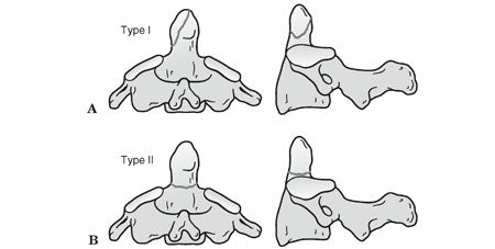 Odontoid Process Dens Fractures: Understanding Risks & Recovery