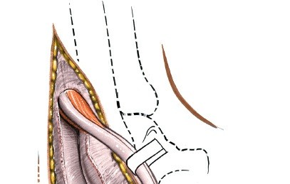 Illustration 124 for Optimized Approaches to the Dorsum of the Foot & Ankle