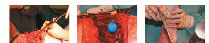 Illustration 11 for Hip Reimplantation Surgery: The Solution for Infected Implants