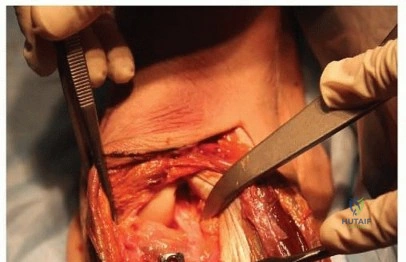 Masterclass: Open Dorsal Approach Scaphoid Fracture Fixation with Corticocancellous Bone Grafting