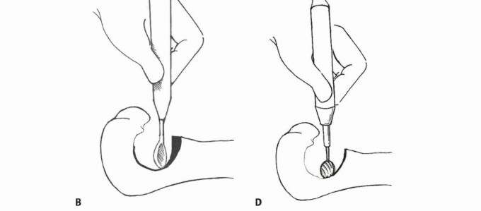 Illustration 6 for Avoid Major Surgery: Bone Tumor Treatment with Liquid Nitrogen Pour
