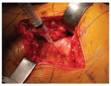 Illustration 11 for Uncemented Acetabular Revision: Optimizing Hemispherical Cup Use