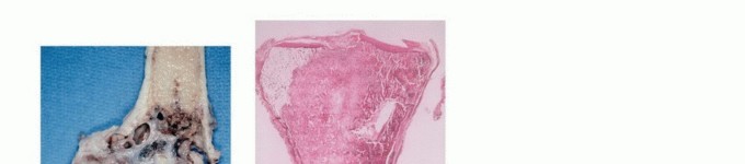 Illustration 10 for Precision Biopsy of Musculoskeletal Tumors for Accurate Diagnosis
