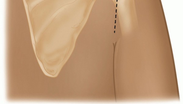 Illustration 12 for Finally Treat Recurrent Posterior Instability of the Shoulder