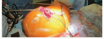 Illustration 31 for Uncemented Acetabular Revision: Optimizing Hemispherical Cup Use