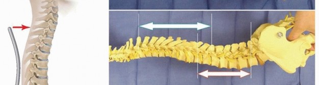 Illustration 20 for Duchenne Muscular Dystrophy: Is Spinal Fusion the Answer?