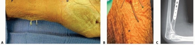 Illustration 12 for Galeazzi DRUJ Stabilization: Unlocking Stability with Smooth Stainless Steel