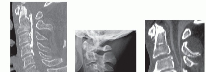 Illustration of corpectomy and fusion - Dr. Mohammed Hutaif