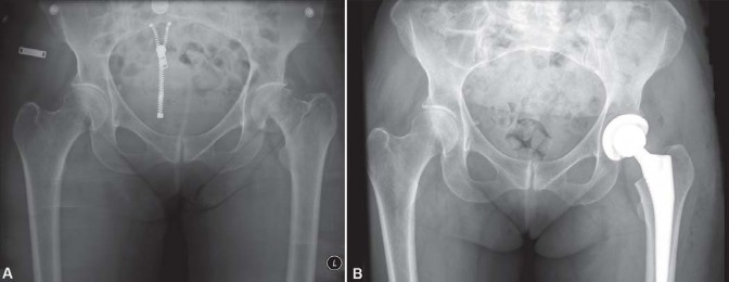 Illustration 10 for Optimal Arthroplasty in Proximal Fractures: What You Need to Know