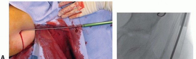 Illustration 17 for Pediatric Femoral Nailing: Targeting the Right aspect of the greater Trochanter