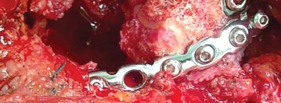 Illustration 25 for Management of Periprosthetic Fractures: An Expert Surgical Guide