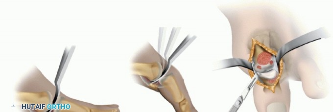 Illustration 7 for Mastering Extensive Plantar Release for Hallux Rigidus