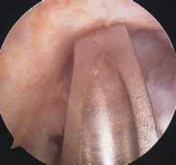 Illustration 66 for Optimizing Single-Bundle Anterior Cruciate Ligament Repair