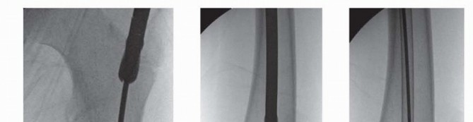 Illustration 19 for Pediatric Femoral Nailing: Targeting the Right aspect of the greater Trochanter