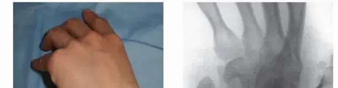 صورة توضيحية لـ كسر عظم الزورقي في الرسغ: دليلك الشامل للعلاج والتعافي مع الأستاذ الدكتور محمد هطيف