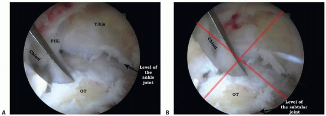 Illustration 23 for Posterior Talar Process: Endoscopic Solutions for Ankle Pain