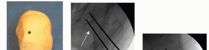 Illustration 10 for Is a Sliding Hip Screw Best for Your Femoral Neck Fracture?