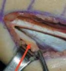 Illustration 8 for Unlocking Mobility: Distal Lengthening for Lateral Hamstring Muscle