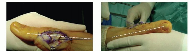 Illustration 25 for Mastering the Biplanar Distal Chevron for Effective Bunion Surgery