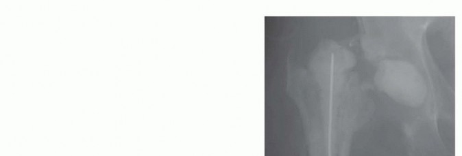 Illustration 13 for Resection Arthroplasty & Spacers: Optimizing Time of Reimplantation