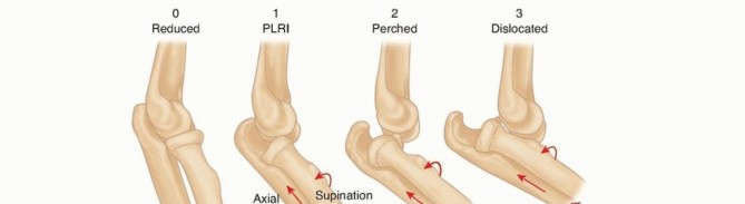Dislocated Elbow J Bone? Simple Management & Recovery Guide
