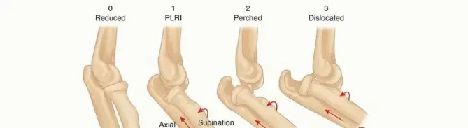 صورة توضيحية لـ خلع الكوع البسيط: دليل شامل للمرضى نحو التعافي الكامل مع الأستاذ الدكتور محمد هطيف