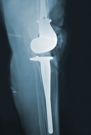 Illustration 45 for Hinged Total Knee: The Salvage Solution for Challenging Cases