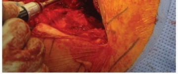 Illustration 12 for Extended Trochanteric Osteotomy: How et al Extended Revision THA Solutions
