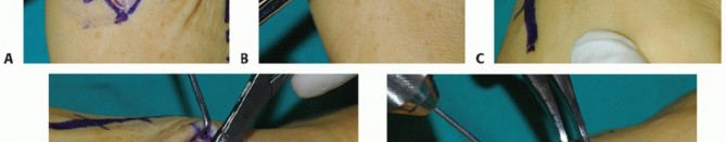 Illustration 4 for Mastering Midfoot Arthrodesis: Protect the Deep Neurovascular Bundle