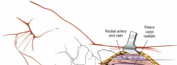 Illustration 4 for Volar Approach: Optimal Exposure for the Volar aspect of the Distal Radius