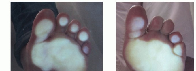 Illustration 6 for Plantar Plate Repair: End Lesser Toe Pain & Instability
