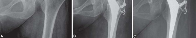 Illustration 34 for Expert Bone Grafting for Primary Total Hip Replacement Success