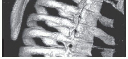 Illustration 7 for Snapping Scapula Syndrome: Why Your Shoulder Clicks & What to Do