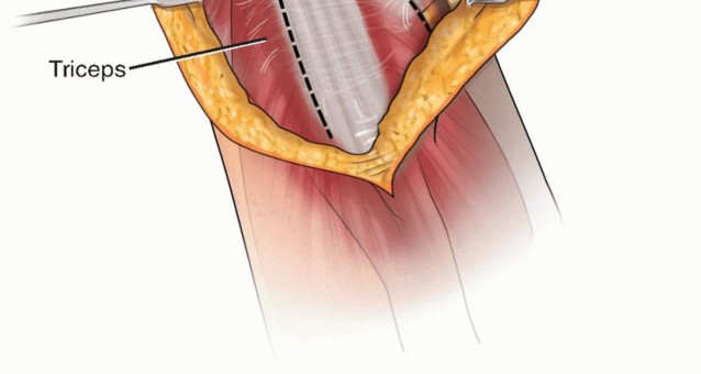 Illustration 42 for Surgical Approaches to Shoulder & Elbow: Pearls and Pitfalls
