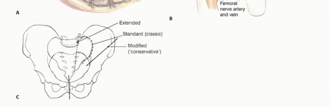 Illustration 3 for Posterior Flap Hemipelvectomy: Mastering Techniques for Optimal Outcomes