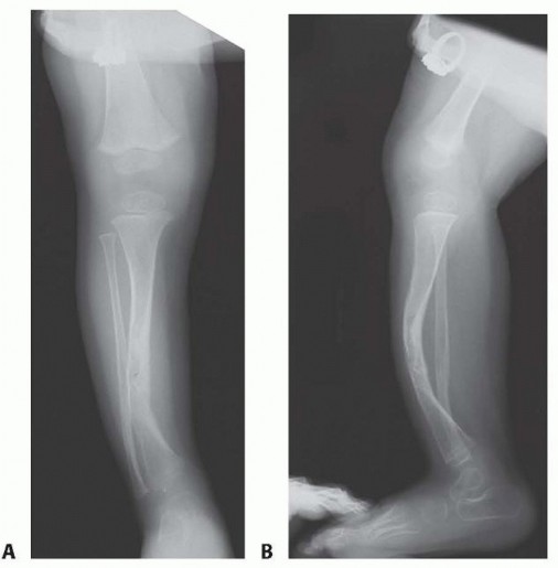 Illustration 3 for Williams Rod: Achieve Stability for Pseudarthrosis within the Tibia