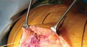 Illustration 25 for Minimally Invasive Subvastus: The Best Path to Quicker TKA Recovery