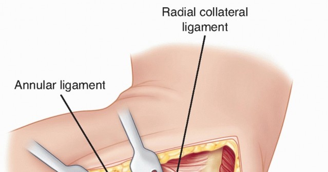Illustration 27 for Radial Head Arthroplasty: Restoring Elbow Function & Stability