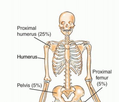 Illustration 32 for Understanding Benign Bone Tumors: Your Complete Preoperative Guide