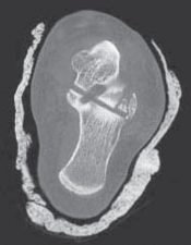 Illustration 35 for Talar Neck Fracture Treatment: Optimizing Recovery with ORIF